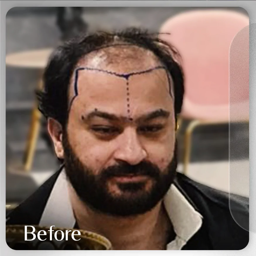 Before hairline FUE hair transplant Islamabad