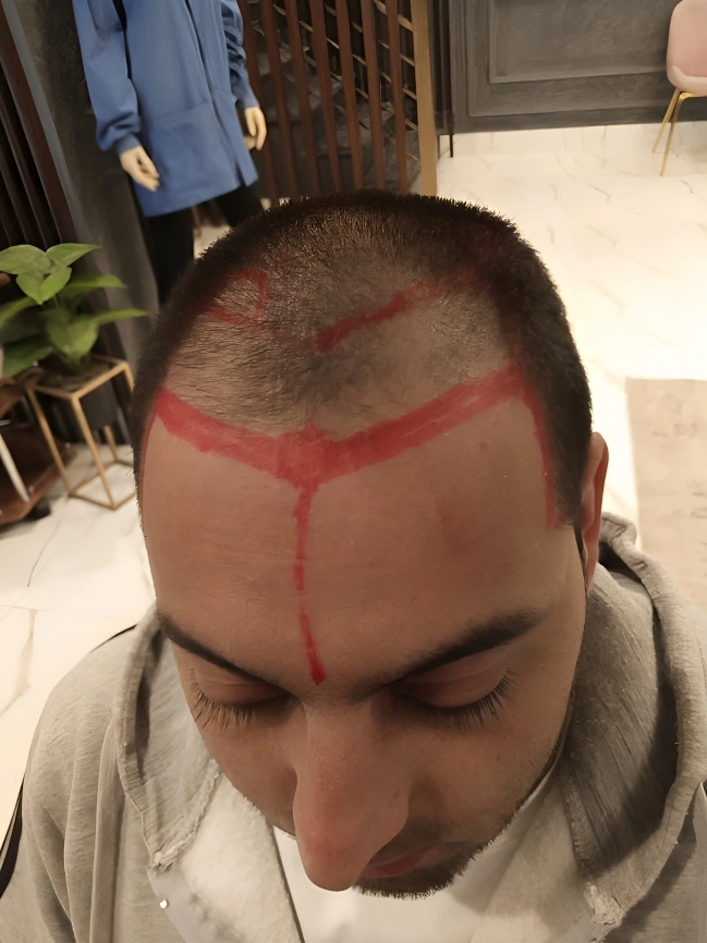 Before frontal hair transplant result