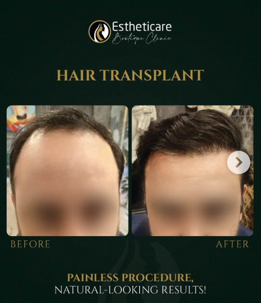Hair transplant before and after – hairline restoration at Estheticare Islamabad