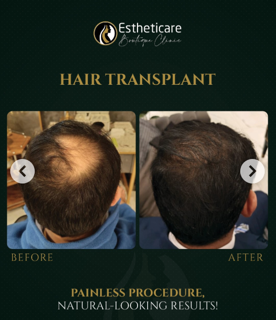 Crown hair transplant before and after – Estheticare Islamabad