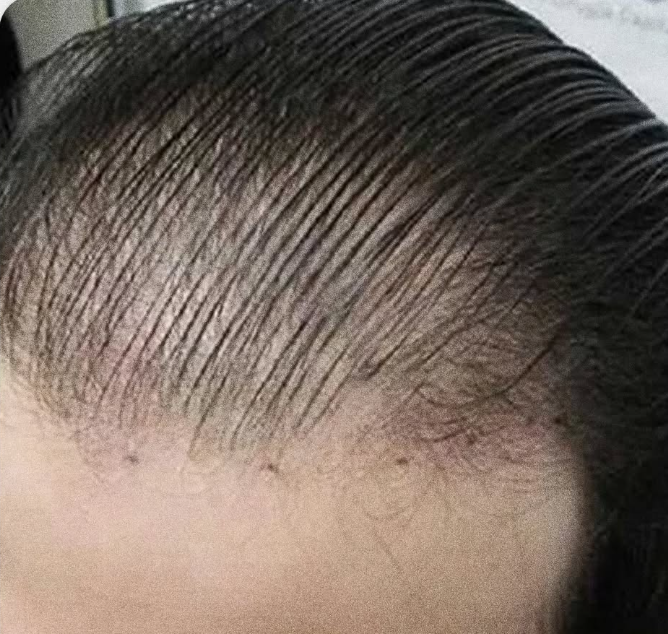 Before hairline density after FUE