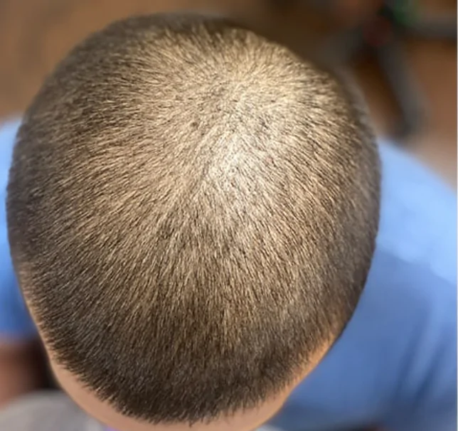 Before crown density after hair transplant