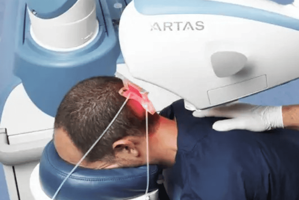 Robotic hair transplant at Estheticare Islamabad